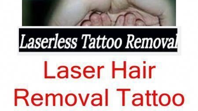 My Tattoo Removal Story