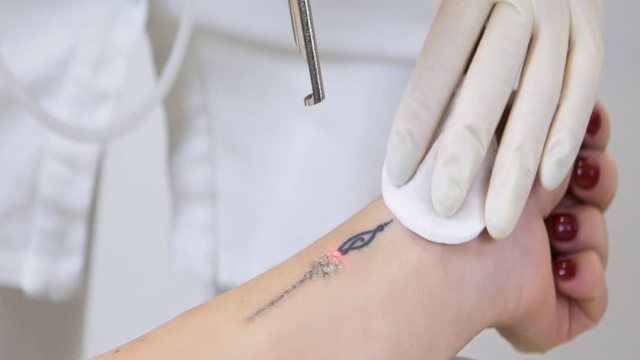 It May Not Be Fun – Tattoo Removal Pain Management