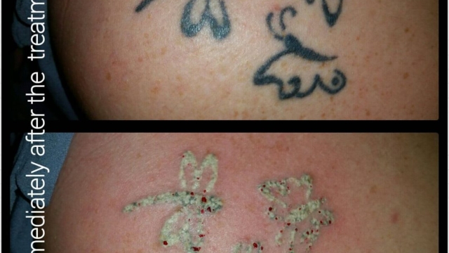 Tca Tattoo Removal – Ideal For Removing Leg Tattoos