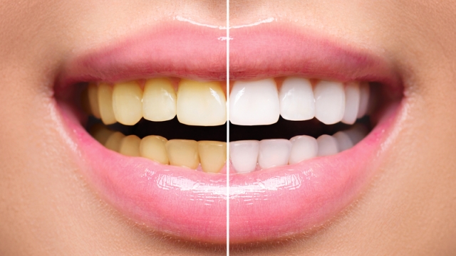 Bright Smiles: Unveiling the Secrets of Teeth Whitening
