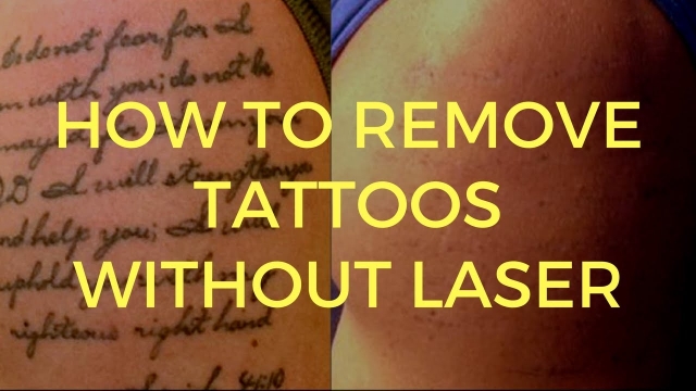 No Longer Want That Tattoo? Tips To Get Your Tattoo Removed