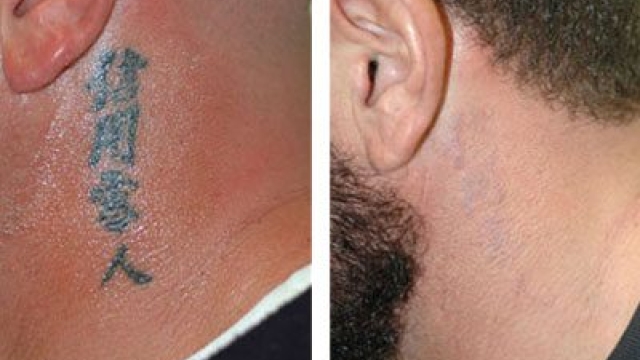 Tattoo Removal By Laser – Are You Certain This Will Be The Method You Wish To Use?